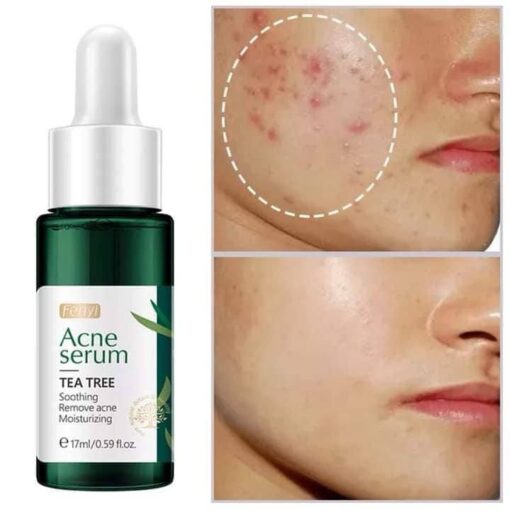 Fenyi Acne Serum -17ml